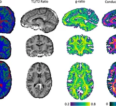 microstructural differences present on diffusion tensor imaging of brains of individuals with ASD