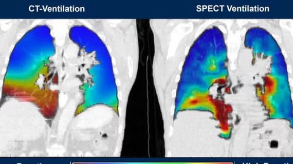 AI software improves diagnosis of lung conditions when contrast cannot be used