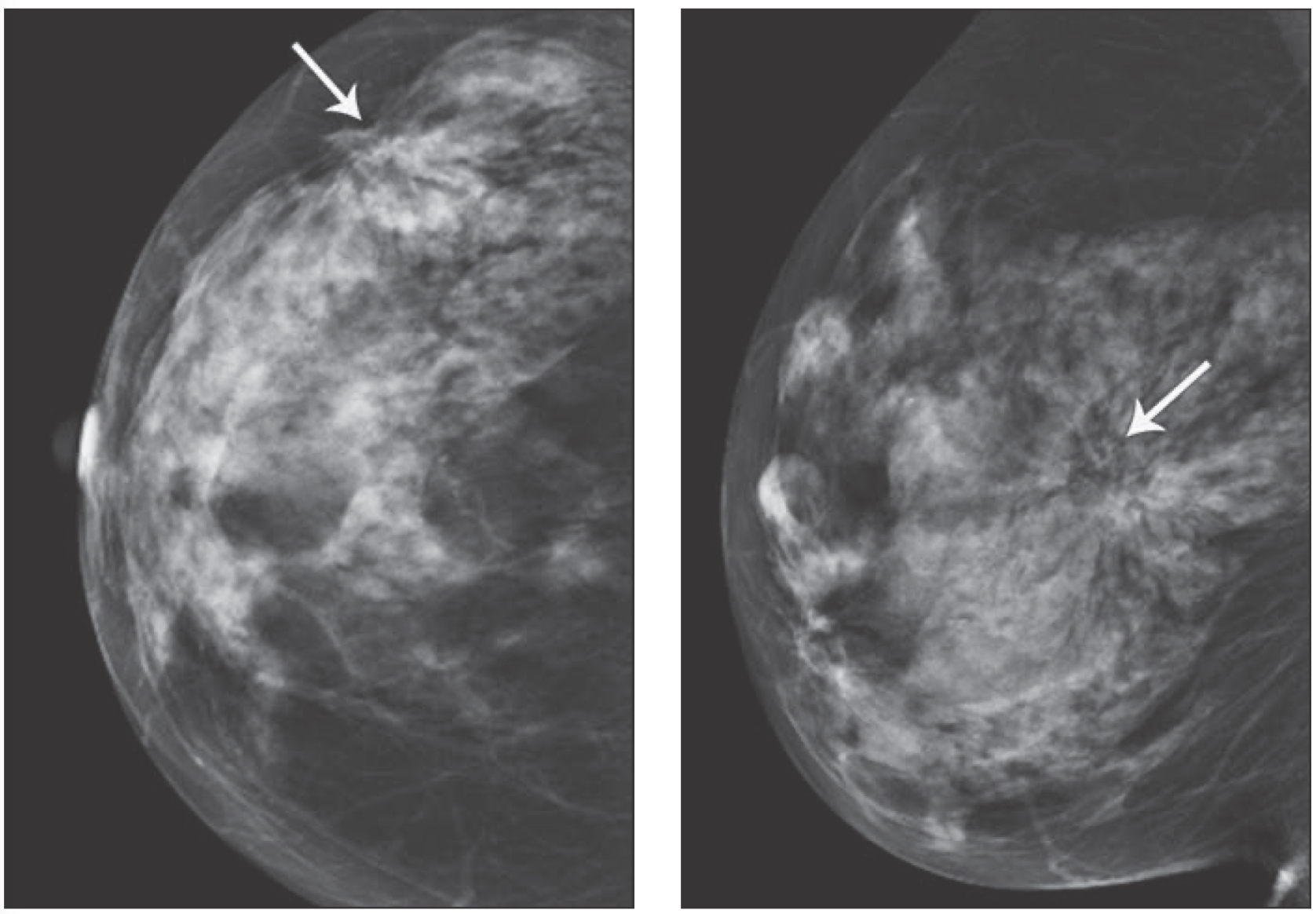 3-D breast area and breast area difference (BAD) calculation in cm 2 on