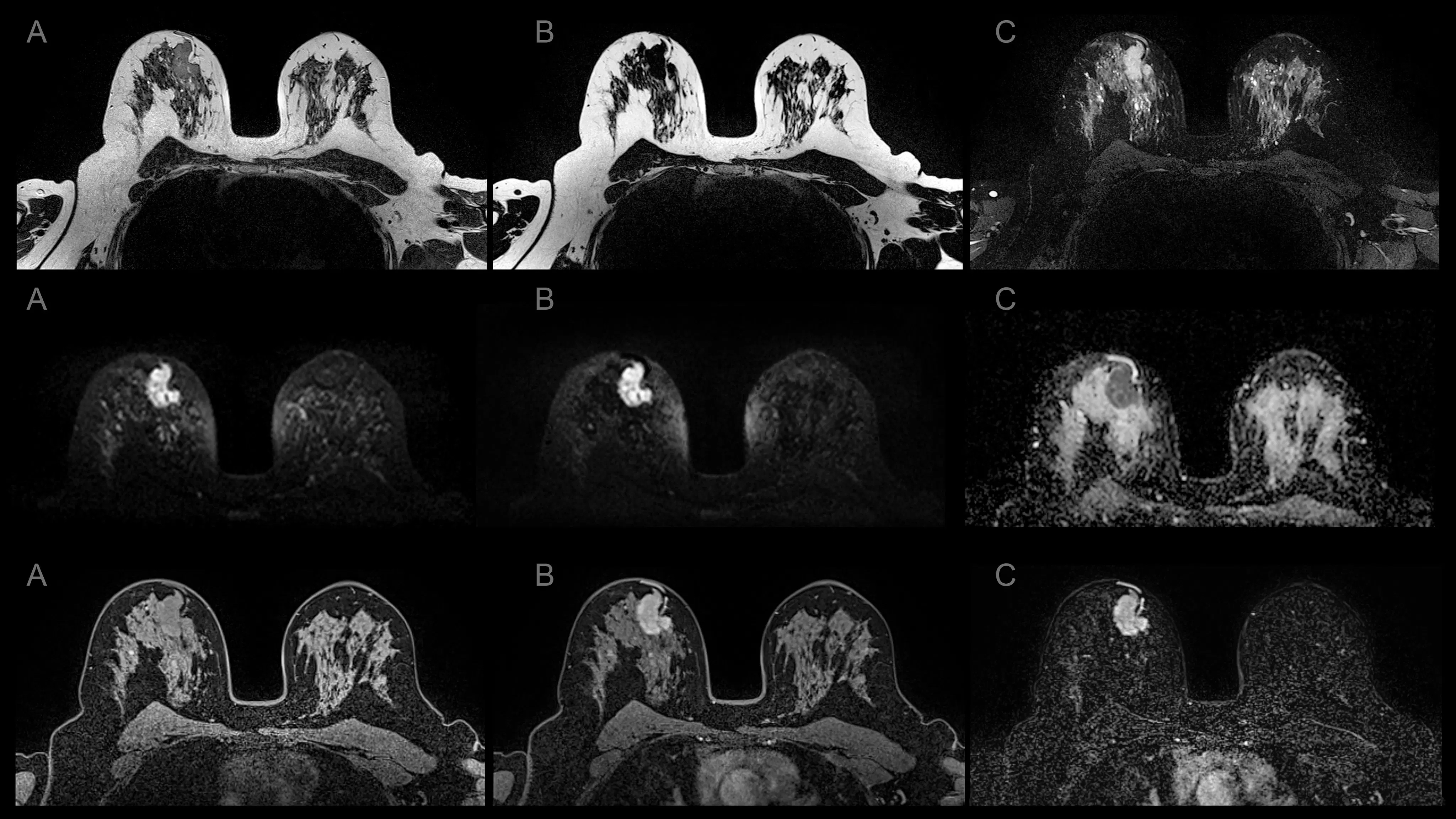 Imaging in Breast Cancer, ling na bayer 