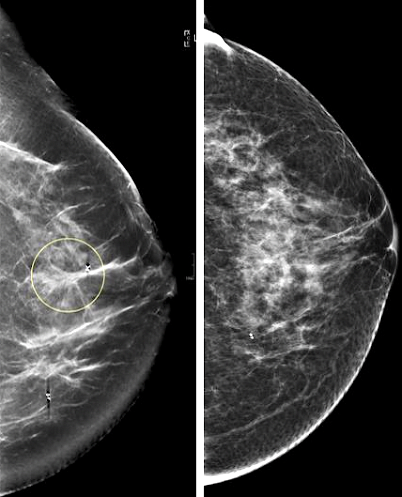 Mammogram images: Normal, abnormal, and breast cancer