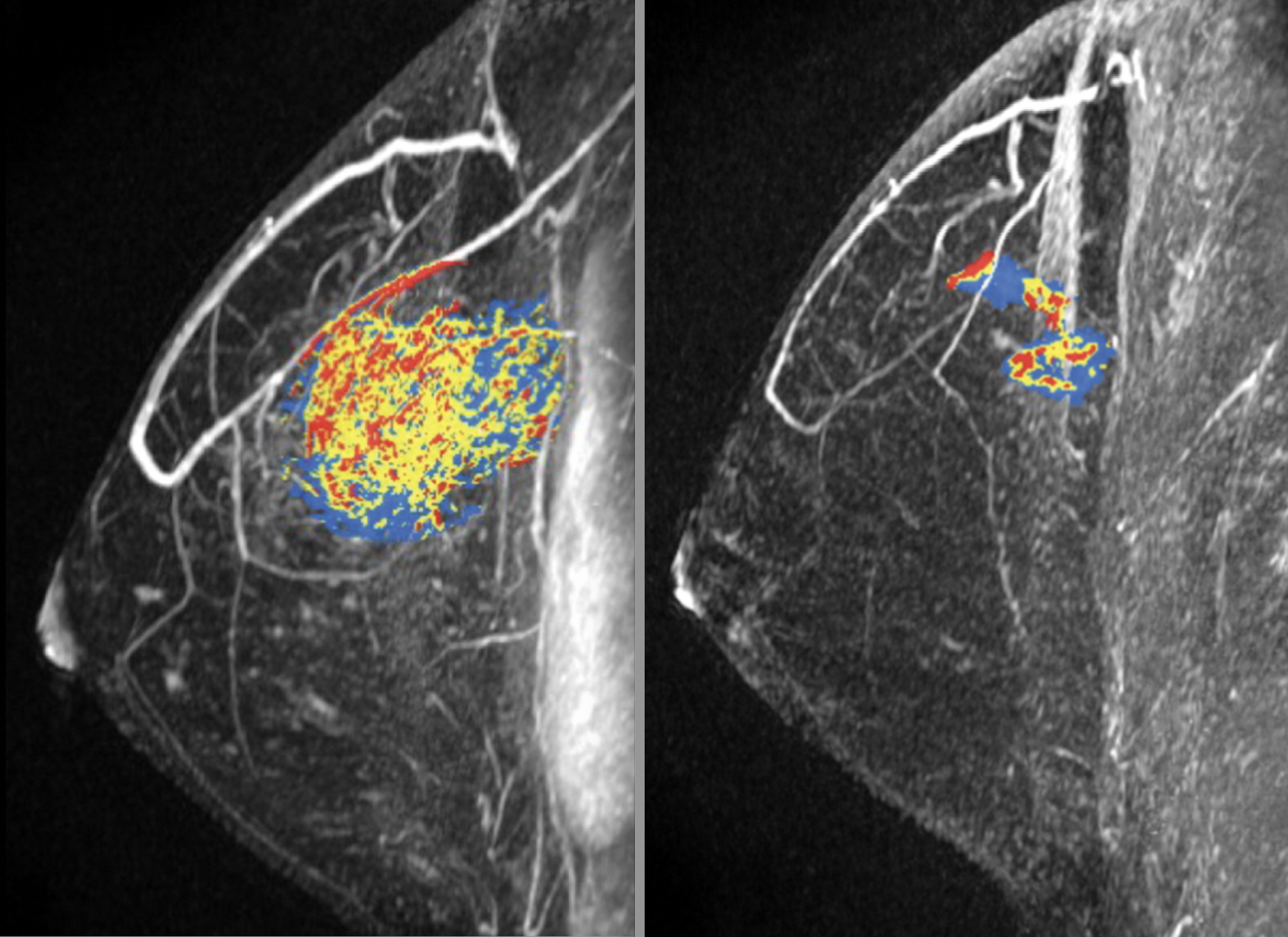 PHOTO GALLERY: What does breast cancer look like on mammography