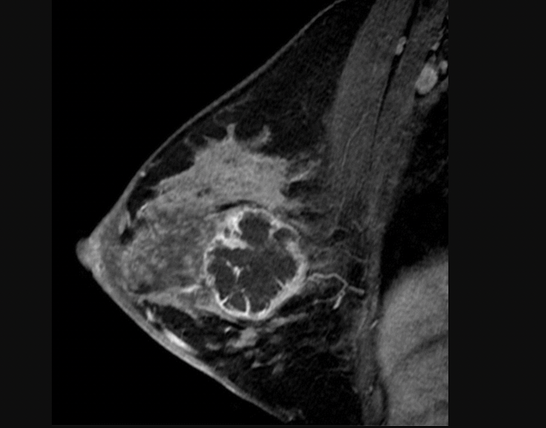 Imaging in Breast Cancer