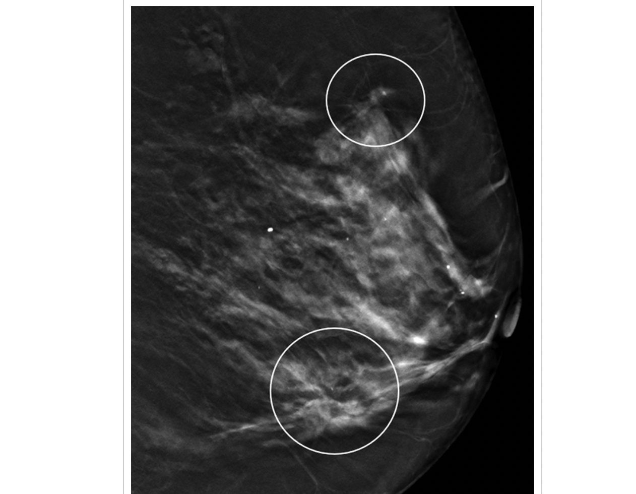 Showing marked breast asymmetry with a huge right breast mass and its
