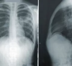 Chest X-ray. Using an explainable artificial intelligence (AI) model, researchers were recently able to accomplish highly accurate labeling on large datasets of publicly available chest radiograph X-rays.. 