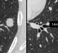 CT scan showing lung cancer nodules with measurements of each nodule to track growth or regression from treatment. Image courtesy of RSNA