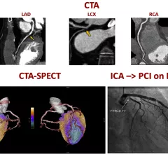 A figure from the 2022 CAD non-invasive imaging guidelines showing a comparison of computed tomography angiography (CTA) and a SPECT-CT vs. an invasive angiogram from the cath lab showing the same blockage in a coronary artery. 