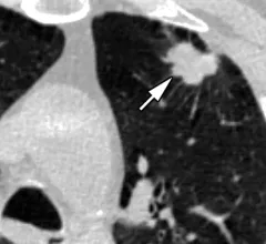 An example of a lung cancer found using low-dose computed tomography (LDCT). Image courtesy of RSNA