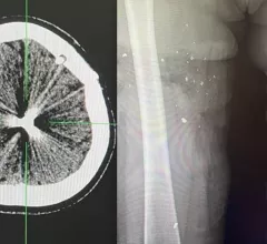 Radiology medical imaging of the wounded in Russian invasion war in Unkraine. #StandwithUkraine #Ukraine #Ukrainewar #RussiaUkraineWar #woundedchildren