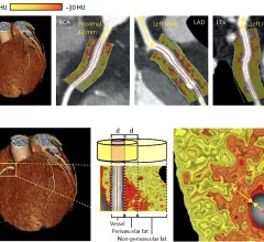 Perivascular fat attenuation index CT scans showing the amount coronary wall inflammation. This measure is being tested in trials to see if it can accurately predict which coronary artery lesions will progress to cause heart attacks. 