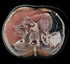 An example of a life-like 3D rendering made from a photon-counting CT scan on the Naeotom Alpha system from Siemens.
