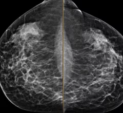 Example of a mammogram showing X-ray images of both the right and left breast and patches of dense breast tissue.