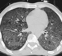 Lung CT of a 42-year-old man with more than 7 days of symptoms. Scans show COVID pneumonia with diffuse ground-glass opacities in close vicinity of visceral pleural surfaces. In addition, a crazy paving pattern is observed. Image courtesy of RSNA. Medical images of COVID. #COVID #SARS-CoV-2