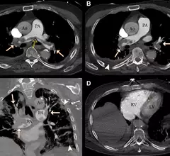 COVID causes increase risk of clotting. Example of a pulmonary embolism. CT pulmonary angiograms in a 77-year-old man with COVID-19 and a saddle embolus to pulmonary arteries (black arrow in A) extending into right and left pulmonary arteries (white arrows) in (A, B) axial and (C) coronal planes. Arrowheads show pulmonary changes associated with COVID-19 and possible lung infarction (black arrow in C). (D) Axial image at the level of the ventricles shows right-sided heart strain. RSNA. COVID PE