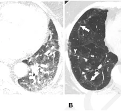 long covid lung CT