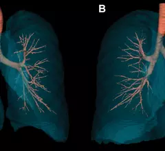 Radiology study compares the lungs of a female and male non-smoker