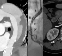 Vascular CT beyond the coronaries includes imaging for aortic aneurism, aortic dissection, SCAD and fibromuscular dysplasia. #SCCT #SCCT2022 #SCAD #yescct 