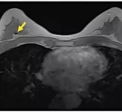 Breast MRI example showing a signal void in right breast (arrow) caused by biopsy on an axial contrast-enhanced in-phase Dixon image. It shows a signal void in right breast (arrow), which corresponded with a MammoMark/CorMark Bread Tie biopsy clip. Image courtesy of AJR.