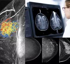 Examples of breast imaging. What does breast imaging look like? What does breast cancer look like? What do radiologists look for on mammograms?