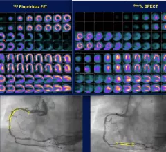 Comparison of flurpiridaz F-18 PET, SPECT and angiography of the 60-year-old female patients in the Aurora trial. The SPECT scan appeared normal, but flurpiridaz was shown to be more sensitive and showed the ischemia from two blockages in the right coronary artery. The new radiotracer may help expand cardiac PET. #ASNC