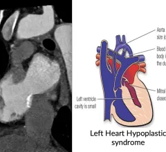 CT imaging showing the congenital heart defect of left heart hypoplastic syndrome.