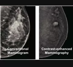 Contrast-enhanced mammography uses iodine contrast injected into a patient and mammography system to image contrast uptake or areas of increased vascular activity, which is typical of cancers. This can help image through dense breast tissue to find cancers that are otherwise masked by dense breast tissue.
