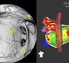 CT has been used for planning and procedural guidance in pulmonary vein isolation (PVI) for about 20 years. It shows the anatomy to the electrophysiologist. The EPs also can load the imaging into their EP mapping system. It also shows them the location of the esophagus and the phrenic nerve so they can avoid these during the procedures. #PVI #EPeeps