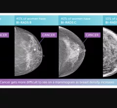 Illustration of the four types of breast tissue densities. The more dense, the harder it is for radiologists to detect cancers, which had led to about 40 states to now require notiofication of patients if they have dense breasts and the impact on their care, with possible miss-reads and that they may need supplemental imaging. 