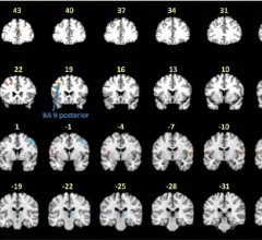 lyme disease on fMRI