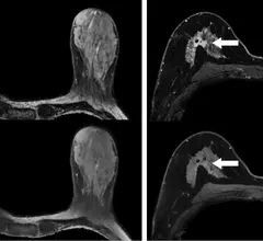 synthetic contrast-enhanced breast MRI