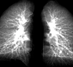 post-covid-lung-story-photo.jpg