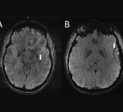 Ultra-high-res MRI Reveals Migraine Brain Changes