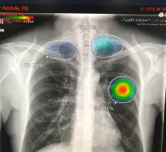 Example of AI automated detection and highlighting of critical lung findings on a chest X-ray for a possible lung cancer nodule and fibrosis. Example shown by AI vendor Lunit.