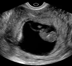 Transvaginal ultrasound of a fetus in early development during the first trimester. Image courtesy of RSNA