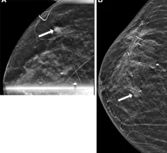 DCIS recurrence on mammogram