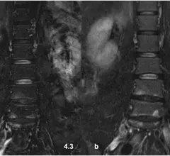 0.55T MRI lumbar compared to 1.5T sequence #lumbarMRI #1.5T