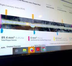 Example of an automated artificial intelligence (AI) assessment of soft coronary plaque from a CT scan from the vendor Cleerly. The AI gives a very detailed report of all the plaque in all the coronary vessels. Some cardiology experts believe this may be the way of the future in screening patients for early coronary disease and monitoring the impact of prevention efforts such as statins to determine if more aggressive treatments are needed.