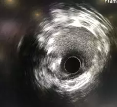 Example of intravascular ultrasound (IVUS) shown as part of the multimodality imaging capability on the Fujifilm CVIS.