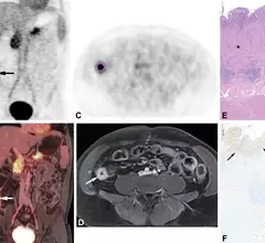 PET/MRI of FAPI radiotracer uptake in Crohn's disease
