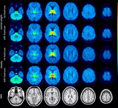 molecular imaging study on brain connections in obese individuals