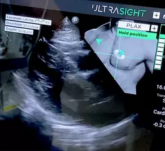 Ultrasight's AI to guide echo cardiac ultrasound POCUS exams at ASE 2023. The thumbnail of the chest shows the user how to the position the transducer and where to move or stop for image acquisition. The bar graph shows the quality of the image.
