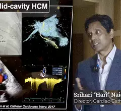 Hari Naidu, MD, explains that inconsistent diagnostic imaging and how it is reported has likely led to a major underdiagnosis of HCM. #ASE #ASE2023 #HCM
