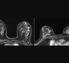  background parenchyma enhancement breast MRI