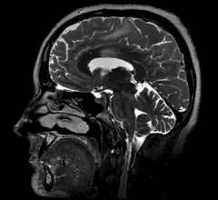 MRI image from a head scan