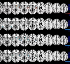 depression and alcohol lead to impairment in functional connectivity of the brain