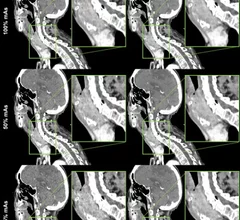 deep learning algorithm slashes radiation dose during neck CT scans