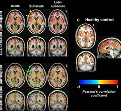 light therapy improves brain connectivity after head trauma