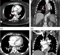 AI tool detects PE missed by rads