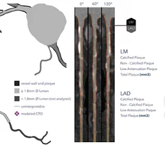 HeartFlow introduced its next generation artificial intelligence (AI) Plaque Analysis with an interactive experience at SCCT 2024. It shows a 3D plaque model and analysis by territory across calcified, non-calcified and low-attenuation plaques. This includes viewing cross-sectional, color-coded images of each plaque type where it was quantified along the vessel. #SCCT #SCCT24 #SCCT2024