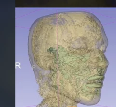 Facial fillers seen on MRI